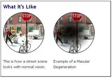 Simulation of Macular Degeneration.  A street scene, alongside a street scene under the simulated effects of Macular Degeneration.